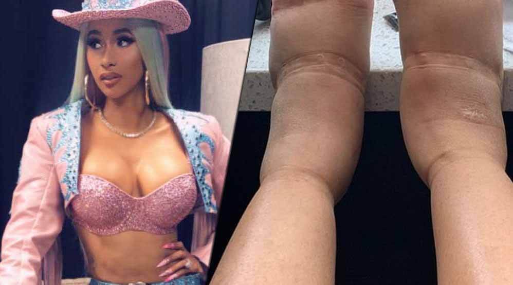 Schonheitsoperation Von Cardi B Geht Schief Raptastisch