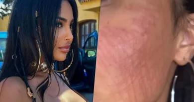 Völlig zerkratzt – Mary enthüllt, was mit ihrem Gesicht passiert ist